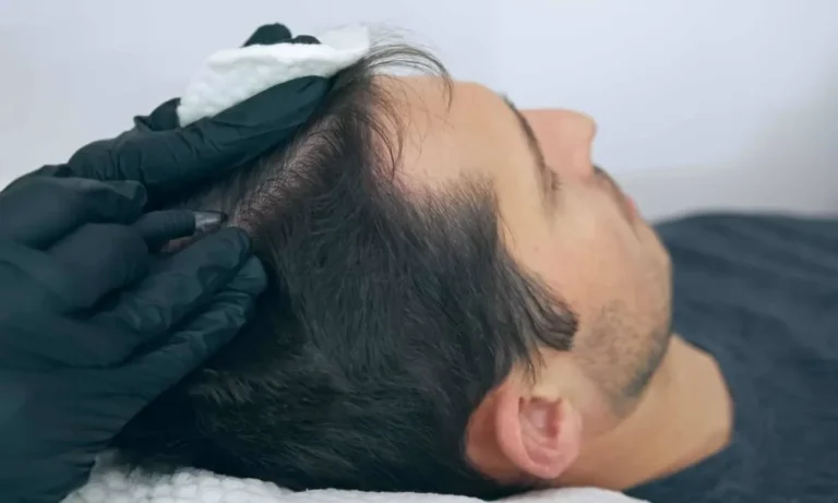 Scalp micropigmentation